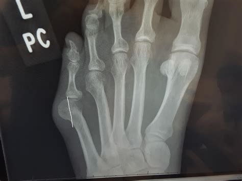 Bunion Surgery Recovery Time Running at Patty Armbruster blog