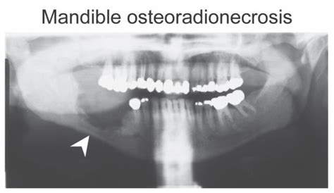 Diagnostic and Therapeutic Approaches to Jaw Osteoradionecrosis