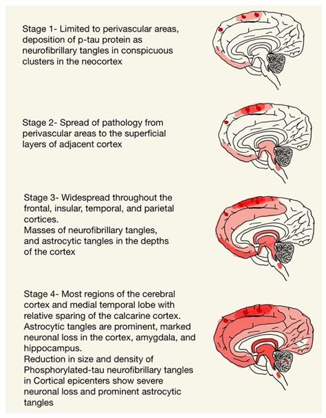 Understanding the Molecular Progression of Chronic Traumatic ...