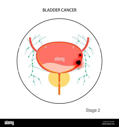 Bladder cancer stages, illustration Stock Photo - Alamy