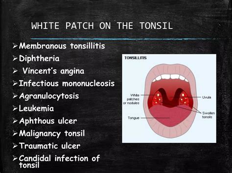 White patch on the tonsil – differential diagnosis | PPTX