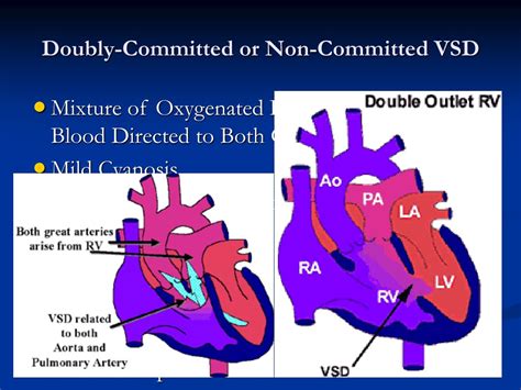 PPT - Double Outlet Right Ventricle - Spectrum, Variations, and ...