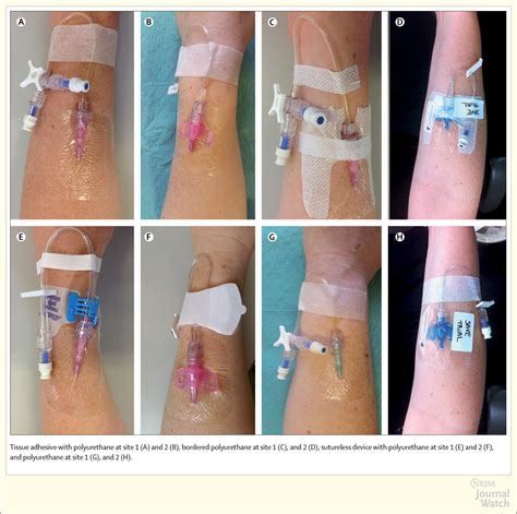 Best Method for Securing and Dressing Peripheral Intravenous Catheters