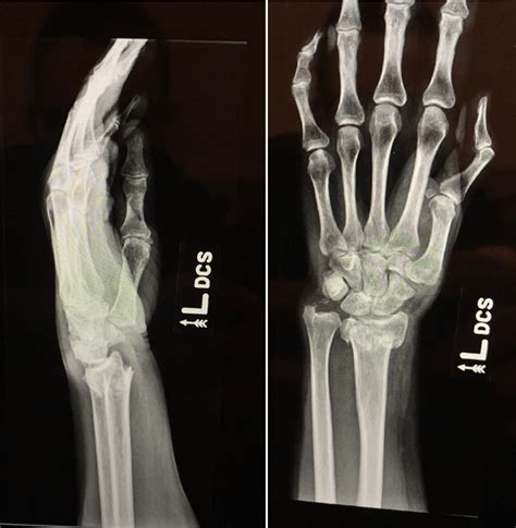 Image result for Simple Radius Fracture