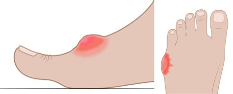 BUNIONS and HALLUX VALGUS - Insoles and Orthotics - Healthy Step