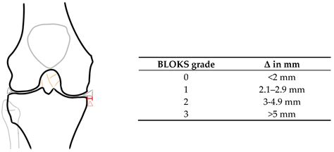 The Impact of Medial Meniscal Extrusion on Cartilage of the Medial ...