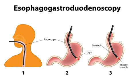 Routine Esophagogastroduodenoscopy Has Little Impact on GERD Management ...
