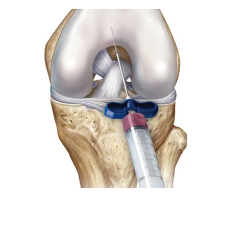 Knee Aspiration | Knee Draining | Arthrocentesis | Knee Arthrocentesis | Knee Swelling | Water ...