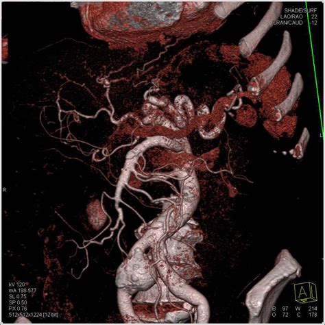 Type B Dissection and Right Common Iliac Artery Aneurysm - Vascular Radiology Case Studies ...