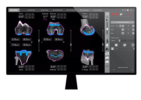 Mako Total Knee 2.0 | Stryker