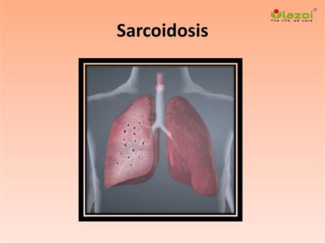 PPT - Sarcoidosis: Causes, Symptoms, Daignosis, Prevention and Treatment PowerPoint Presentation ...