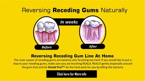 Reversing Receding Gums