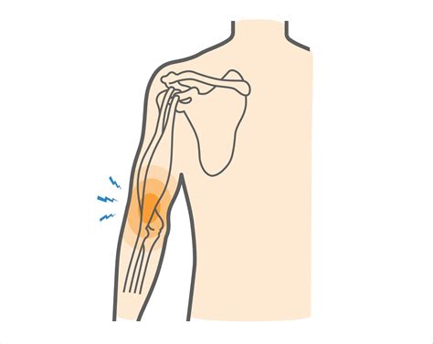 Inner Bicep Pain Biceps Tendonitis London | Shoulder Pain London