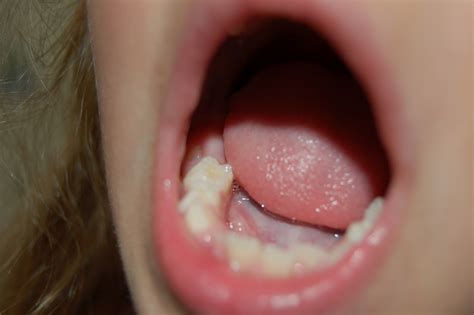 Piper's Blog: 6-year molars are coming in!