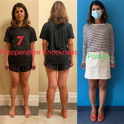 Knock Knee Deformity Before and After Photos – Limb Lengthening