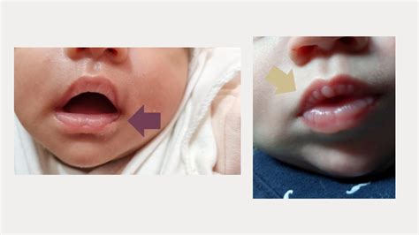 What You Need To Know About Suck Blisters - Arkansas Lactation