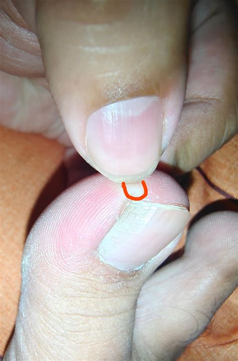 Feel sharp pain on pressing skin below medial end of great toe's nail. : r/DermatologyQuestions