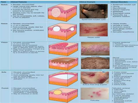 Management of vulval itching caused by benign vulval22 | PPTX