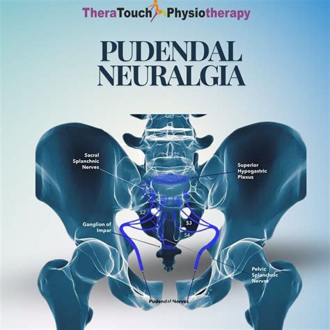 Pudendal Neuralgia: Causes, Symptoms and How You Can Find Relief - TheraTouch Physiotherapy