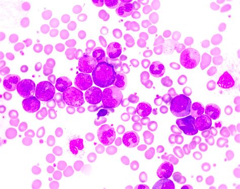 end stage multiple myeloma signs and symptoms - Barbie Keeton