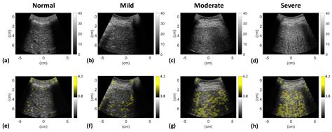 Normal Vs Fatty Liver Ultrasound
