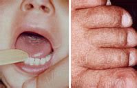 Aplastic Anemia - Welcome to Dr. Subhash Sharma official Website ...