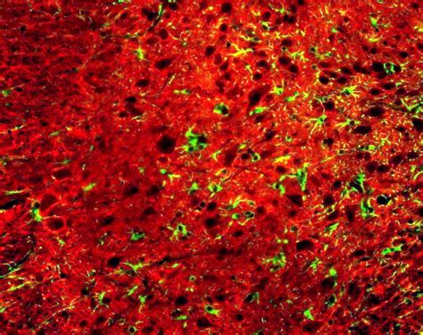 Pills to treat multiple sclerosis offer hope of an end to injections ...