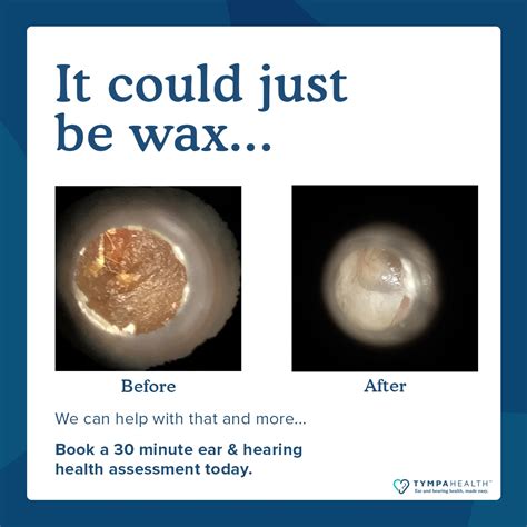 Can you get ear wax removal same day? - Wellness Pharmacy