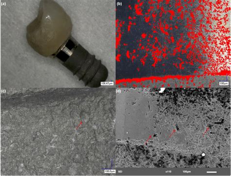 Titanium Corrosion Mechanisms in the Oral Environment: A Retrieval Study