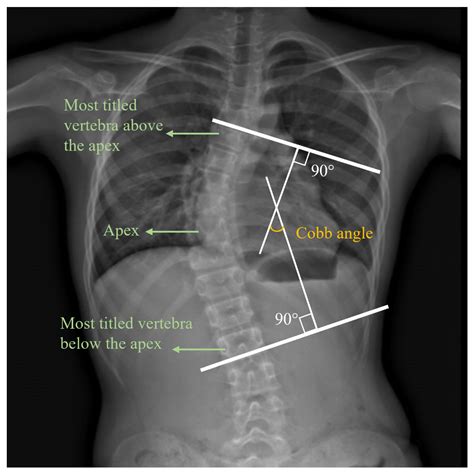 Electromyographic Analysis of Paraspinal Muscles of Scoliosis Patients ...