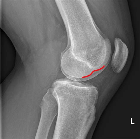 Lateral Femoral Condyle