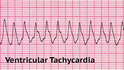 Ventricular Tachycardia Ecg What Is Tachycardia? Symptoms, Causes,