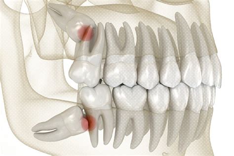 Impacted Wisdom Teeth: Causes, Symptoms, and Treatments in Dubai - The ...