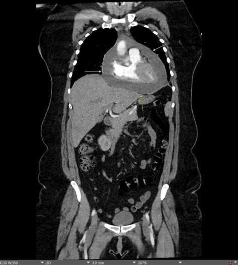 Large Hemorrhagic Pericardial Effusion and Cardiac Tamponade Following BNT162b2 (BioNTech/Pfizer ...