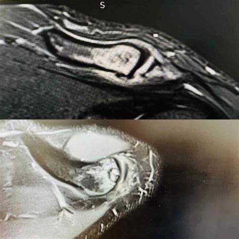 Symptoms Of Osteolysis