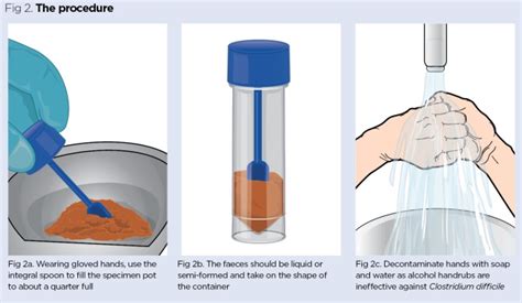 Image result for Stool Sample Collection Procedure