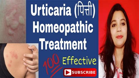 urticaria lupus