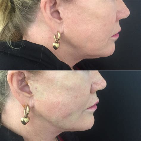 Non-surgical Jowl Lift | Thread Lift, HIFU, Injectables & Fillers for Jowl