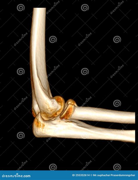 CT scan of elbow joint stock illustration. Illustration of upper - 255352614