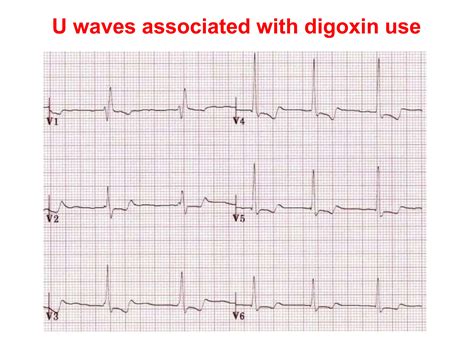 U WAVE IN ECG AND ITS ABNORMALITIES IN ECG | PPTX