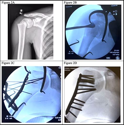 Proximal Humerus Fracture Proximal Humerus Fracture Nonunion And