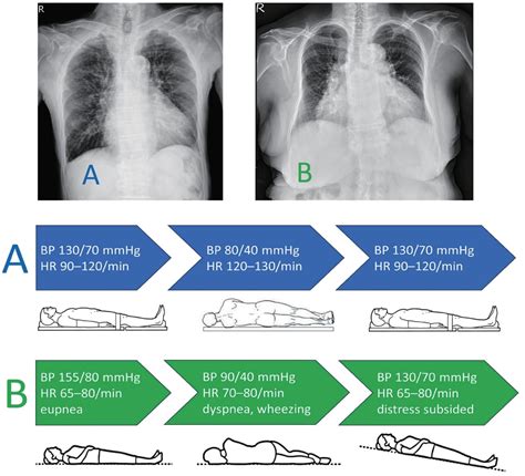 Deteriorating Hypotension and Trepopnea During Left Lateral Decubitus ...
