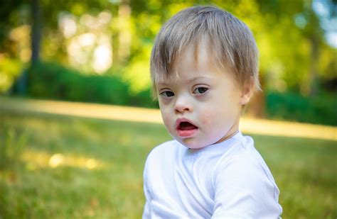 Down Syndrome Is Xxy at Ester Gordan blog