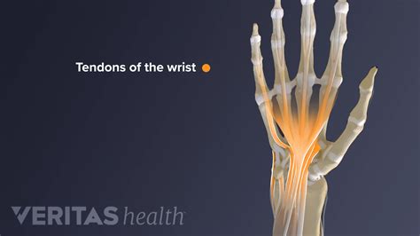 Wrist Tendonitis vs. Sprain