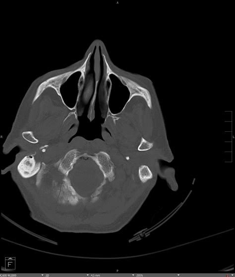 Occipital condyle fracture - by Alexander Baxter - RadNotes