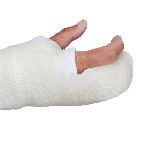 Boxers Fracture Cast