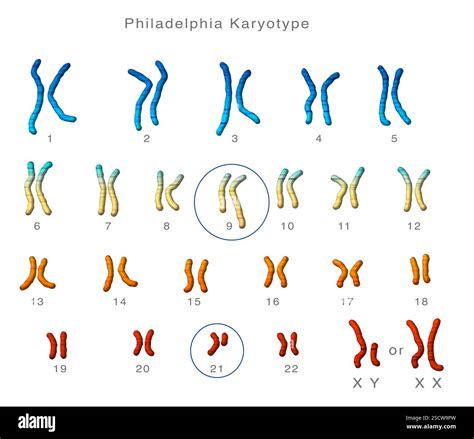 Philadelphia karyotype. Illustration of a male or female karyotype ...
