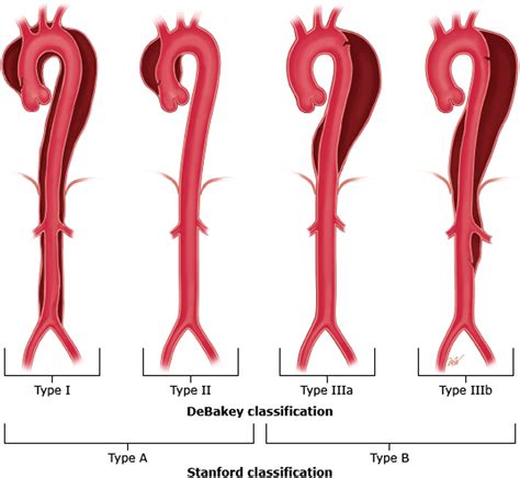 Aortic Dissection - Anesthesiology Clinics