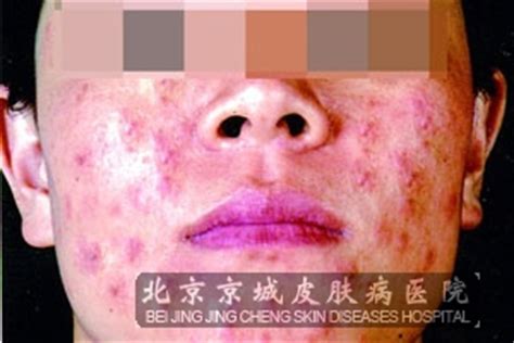 皮肤过敏的原因有哪些_过敏_北京京城皮肤医院(北京医保定点机构)