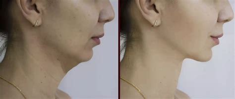 Non-Surgical Jawline & Chin Contouring | Facial Enhancement